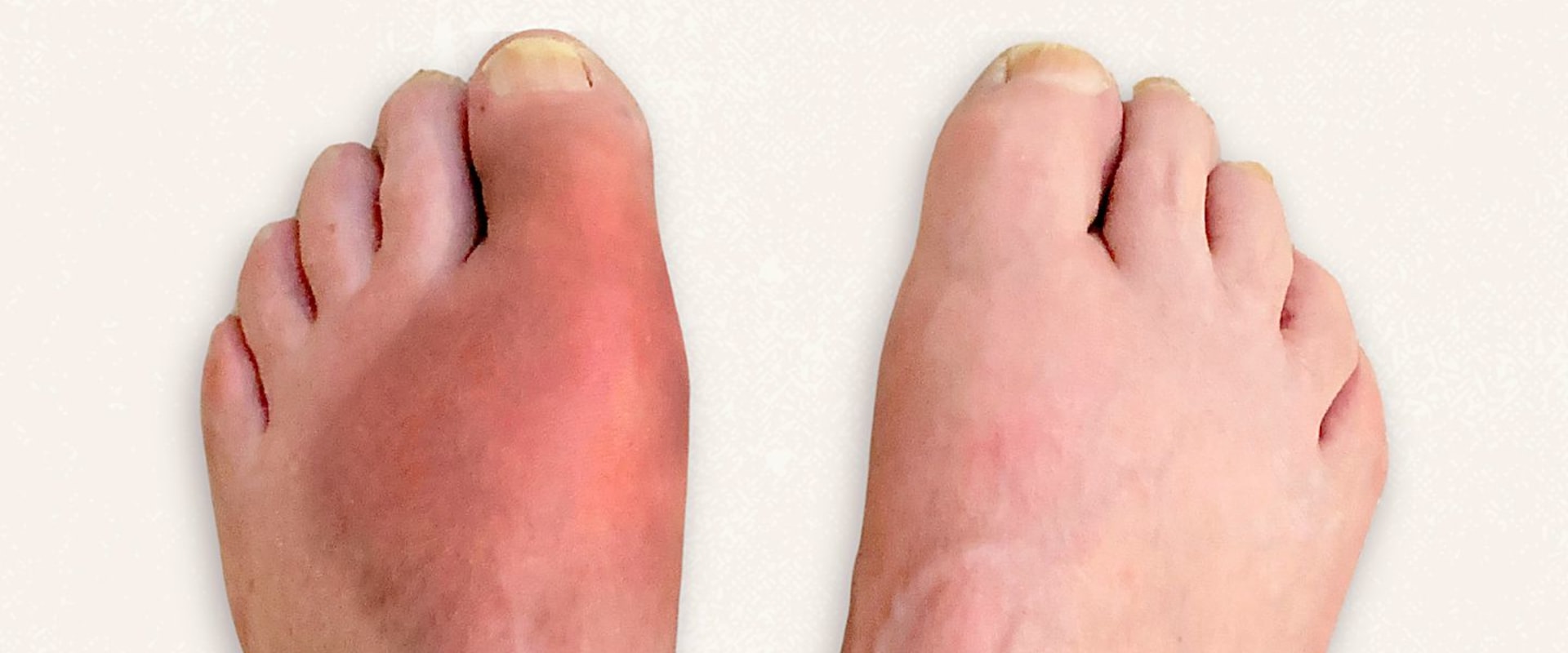 The Most Common and Painful Foot Conditions and How to Treat Them