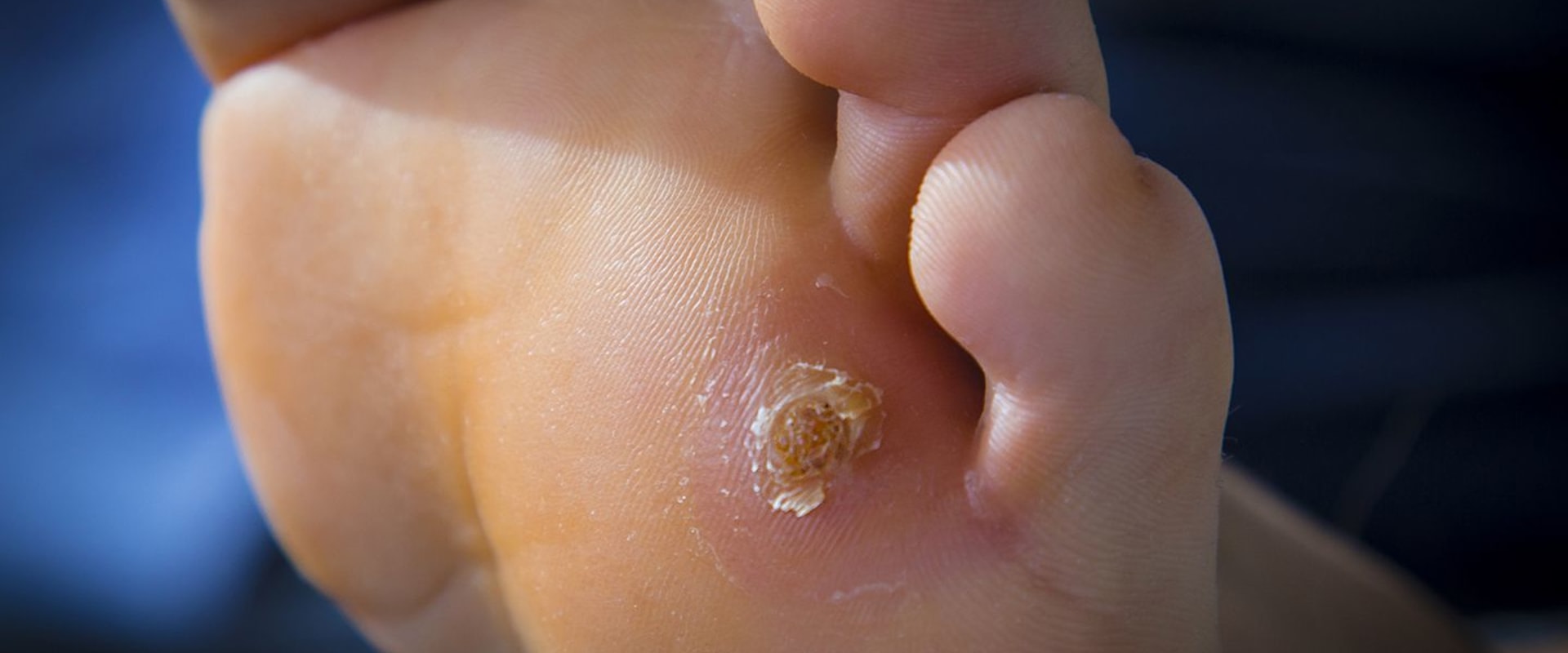 The Most Common Foot Problems and How to Treat Them