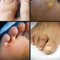 Expert's Guide to Common Foot Disorders