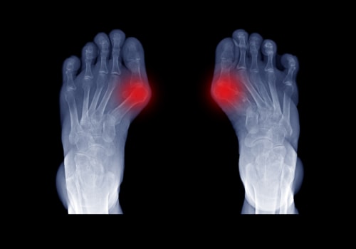 Bunion Surgery: Why Podiatrists are the Best Choice