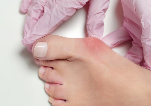 A Foot Specialist's Guide On Whether Can Poor Circulation Be Reversed